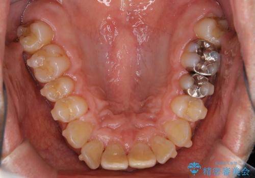 しぶといステインもエアフローワンで1日でキレイに!!の治療後