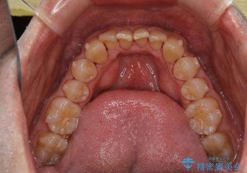 しぶといステインもエアフローワンで1日でキレイに!!の治療後