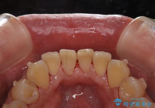 しぶといステインもエアフローワンで1日でキレイに!!の治療後