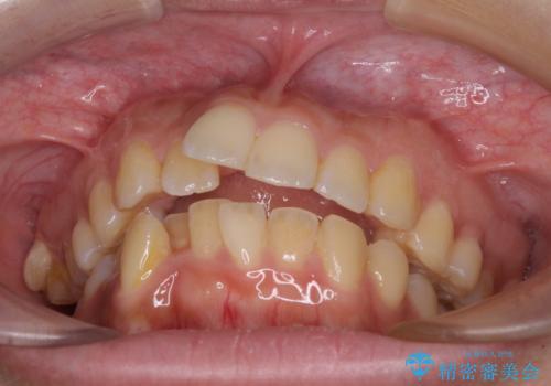 八重歯と上顎前突 ワイヤー装置での抜歯矯正の治療前