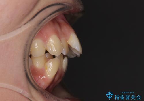 八重歯と上顎前突 ワイヤー装置での抜歯矯正の治療前