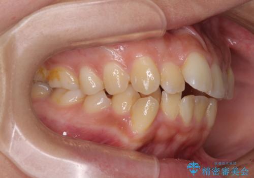 八重歯と上顎前突 ワイヤー装置での抜歯矯正の治療前