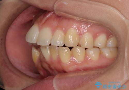 八重歯と上顎前突 ワイヤー装置での抜歯矯正の治療前