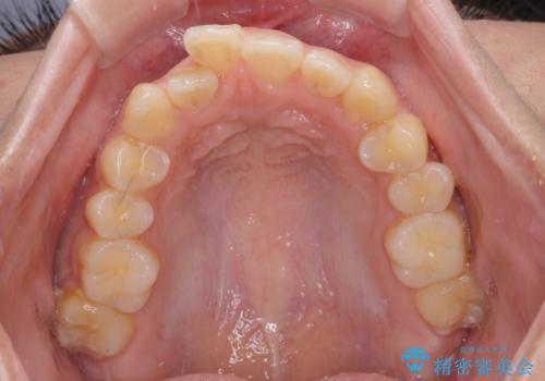 八重歯と上顎前突 ワイヤー装置での抜歯矯正の治療前