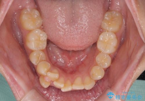 八重歯と上顎前突 ワイヤー装置での抜歯矯正の治療前