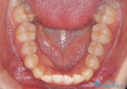 右上小臼歯の捻転を改善|インビザラインと部分ワイヤー矯正のコンビネーション治療の治療前