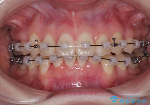 上下の八重歯とクロスバイト ワイヤー装置での抜歯矯正の治療中