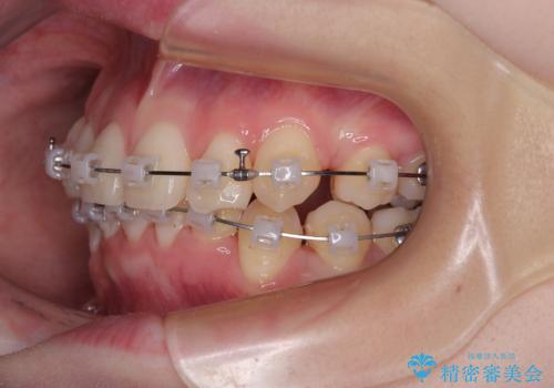 上下の八重歯とクロスバイト ワイヤー装置での抜歯矯正の治療中