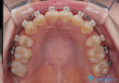 上下の八重歯とクロスバイト ワイヤー装置での抜歯矯正の治療中