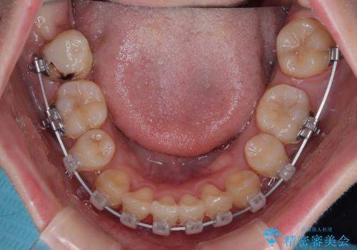 上下の八重歯とクロスバイト ワイヤー装置での抜歯矯正の治療中