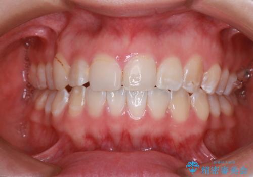 「フルリンガル矯正|アンカースクリューを活用し正中を整えた症例」