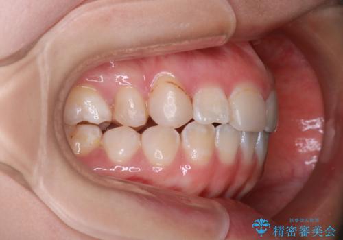 「フルリンガル矯正|アンカースクリューを活用し正中を整えた症例」の治療中