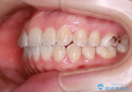 「フルリンガル矯正|アンカースクリューを活用し正中を整えた症例」の治療中