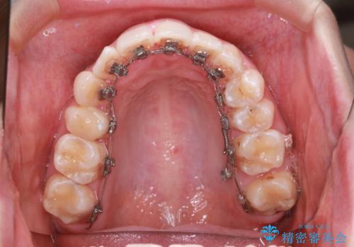 「フルリンガル矯正|アンカースクリューを活用し正中を整えた症例」の治療中