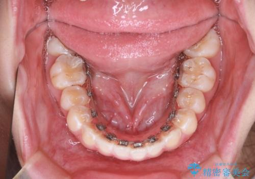 「フルリンガル矯正|アンカースクリューを活用し正中を整えた症例」の治療中