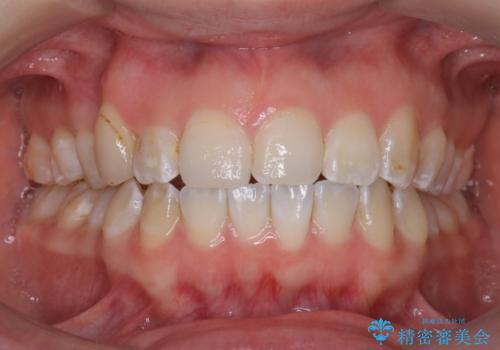 「フルリンガル矯正|アンカースクリューを活用し正中を整えた症例」の症例 治療前