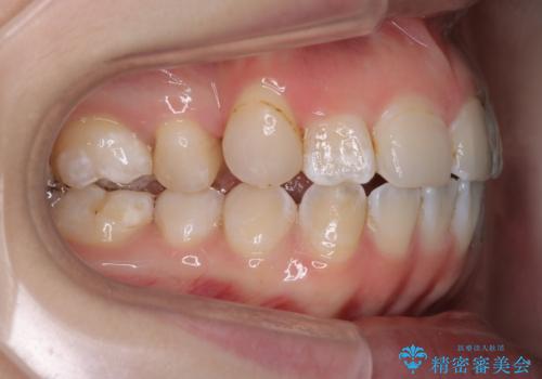 「フルリンガル矯正|アンカースクリューを活用し正中を整えた症例」の治療前
