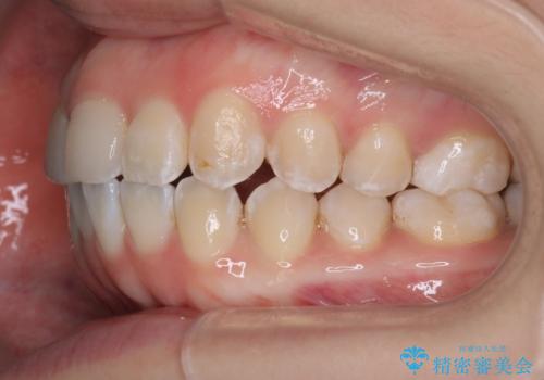 「フルリンガル矯正|アンカースクリューを活用し正中を整えた症例」の治療前