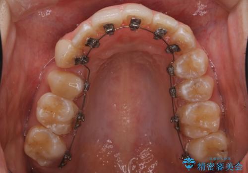 「フルリンガル矯正|アンカースクリューを活用し正中を整えた症例」の治療前