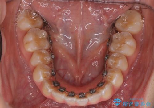 「フルリンガル矯正|アンカースクリューを活用し正中を整えた症例」の治療前