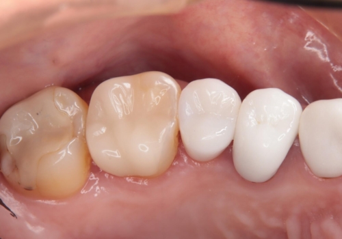 他院のかぶせ物が欠けた 長持ちする形にして新製の治療後