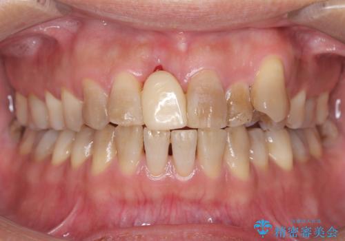 歯周病治療とエアーフロー