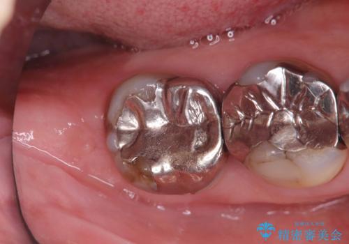 【オールセラミッククラウン】銀歯の下が虫歯に!の症例 治療前