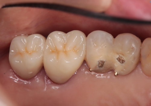 食べ物がはさまる 他院のかぶせ物のやり直しの治療後