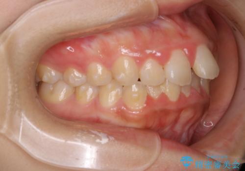 インビザラインが使えなかった:ワイヤーで仕上げ治療の治療前
