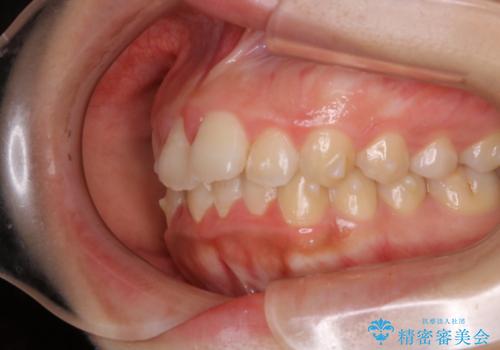 インビザラインが使えなかった:ワイヤーで仕上げ治療の治療前