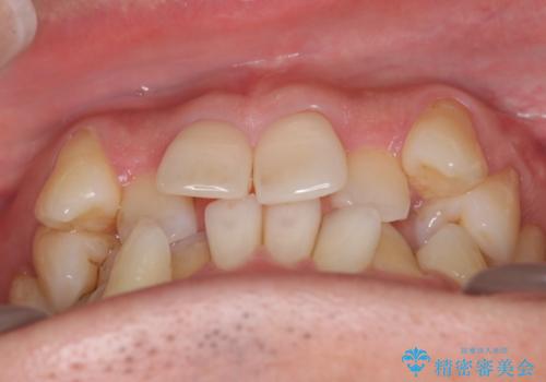 【クリア装置】がたつきを治したいの治療前