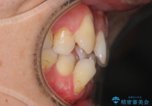 【クリア装置】がたつきを治したいの治療前