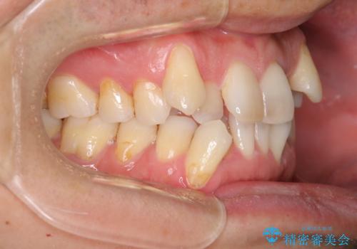 【クリア装置】がたつきを治したいの治療前