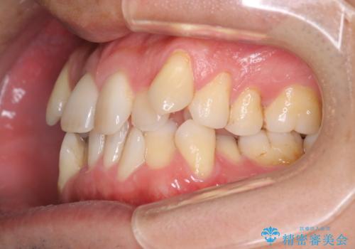 【クリア装置】がたつきを治したいの治療前