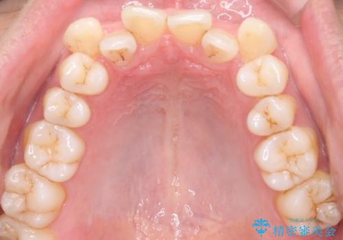 【クリア装置】がたつきを治したいの治療前