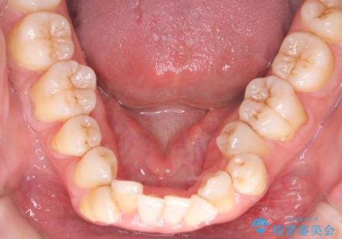 【クリア装置】がたつきを治したいの治療前