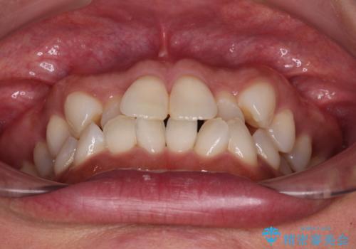 前歯のクロスバイト インビザラインによる矯正治療の治療前