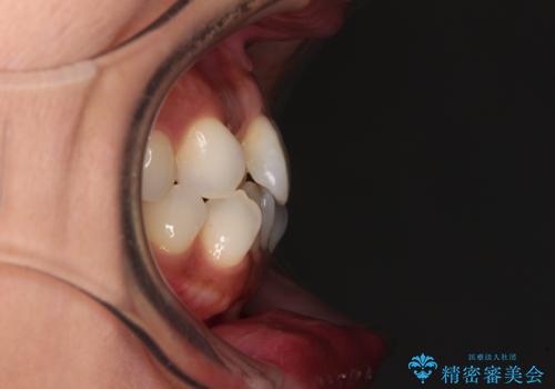 前歯のクロスバイト インビザラインによる矯正治療の治療前