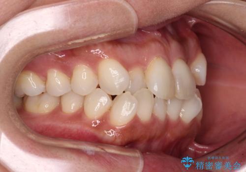 前歯のクロスバイト インビザラインによる矯正治療の治療前