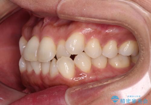 前歯のクロスバイト インビザラインによる矯正治療の治療前