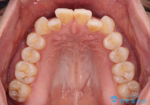 前歯のクロスバイト インビザラインによる矯正治療の治療前