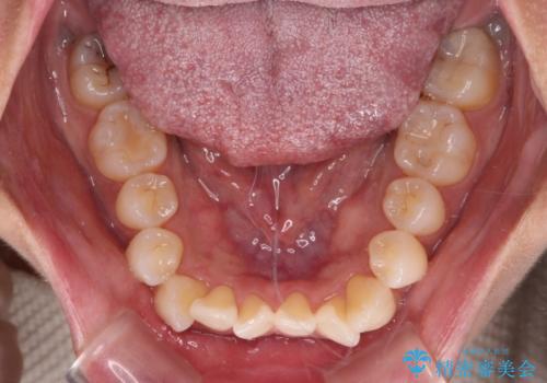 前歯のクロスバイト インビザラインによる矯正治療の治療前
