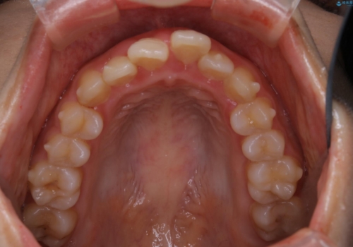 インビザラインが使えなかった:ワイヤーで仕上げ治療の治療前