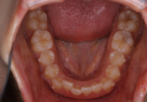 インビザラインが使えなかった:ワイヤーで仕上げ治療の治療前