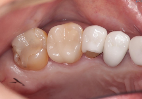 他院のかぶせ物が欠けた 長持ちする形にして新製の治療前