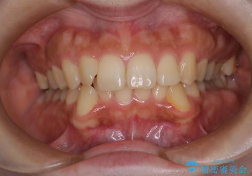 前歯のデコボコを抜歯矯正で改善|アンカースクリューで口元もスッキリ