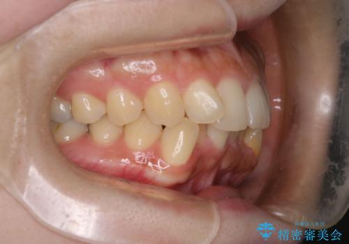 前歯のデコボコを抜歯矯正で改善|アンカースクリューで口元もスッキリの治療前