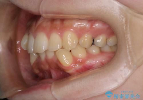 前歯のデコボコを抜歯矯正で改善|アンカースクリューで口元もスッキリの治療前
