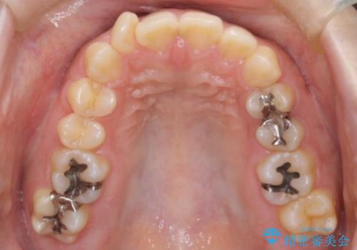 前歯のデコボコを抜歯矯正で改善|アンカースクリューで口元もスッキリの治療前