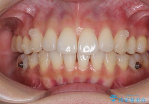 抜歯矯正の軽度後戻りを解消 インビザライン矯正の治療中